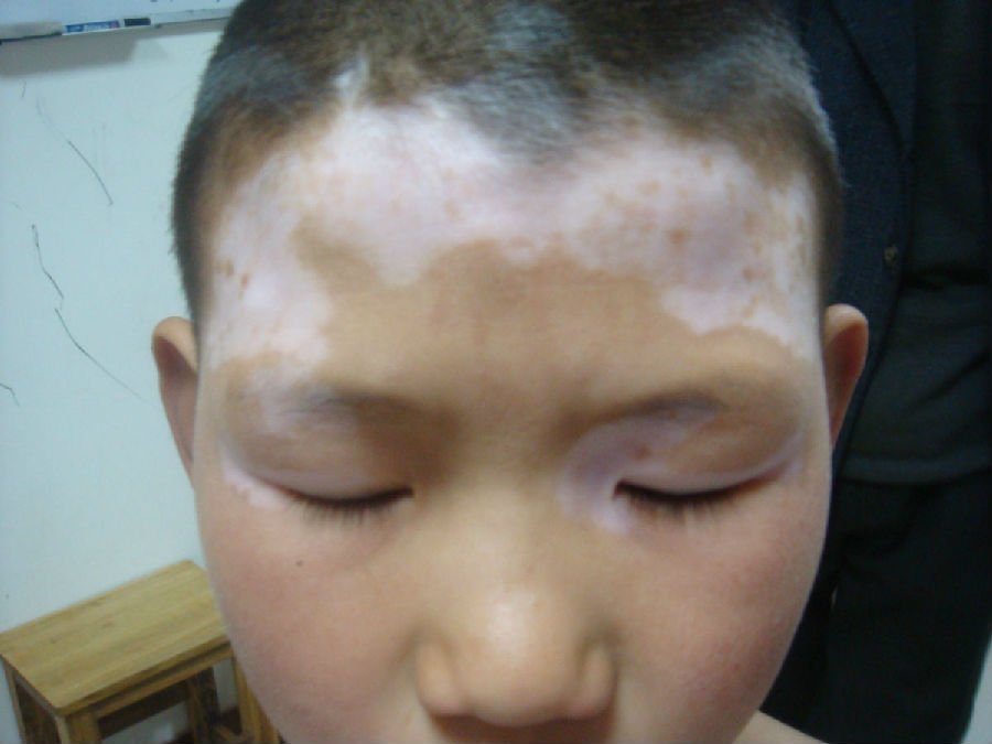 青少年白癜风护理.jpg