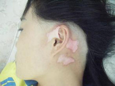 节段型白癜风有什么危害呢.jpg
